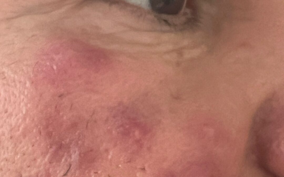 Qué es el Herpes Zóster